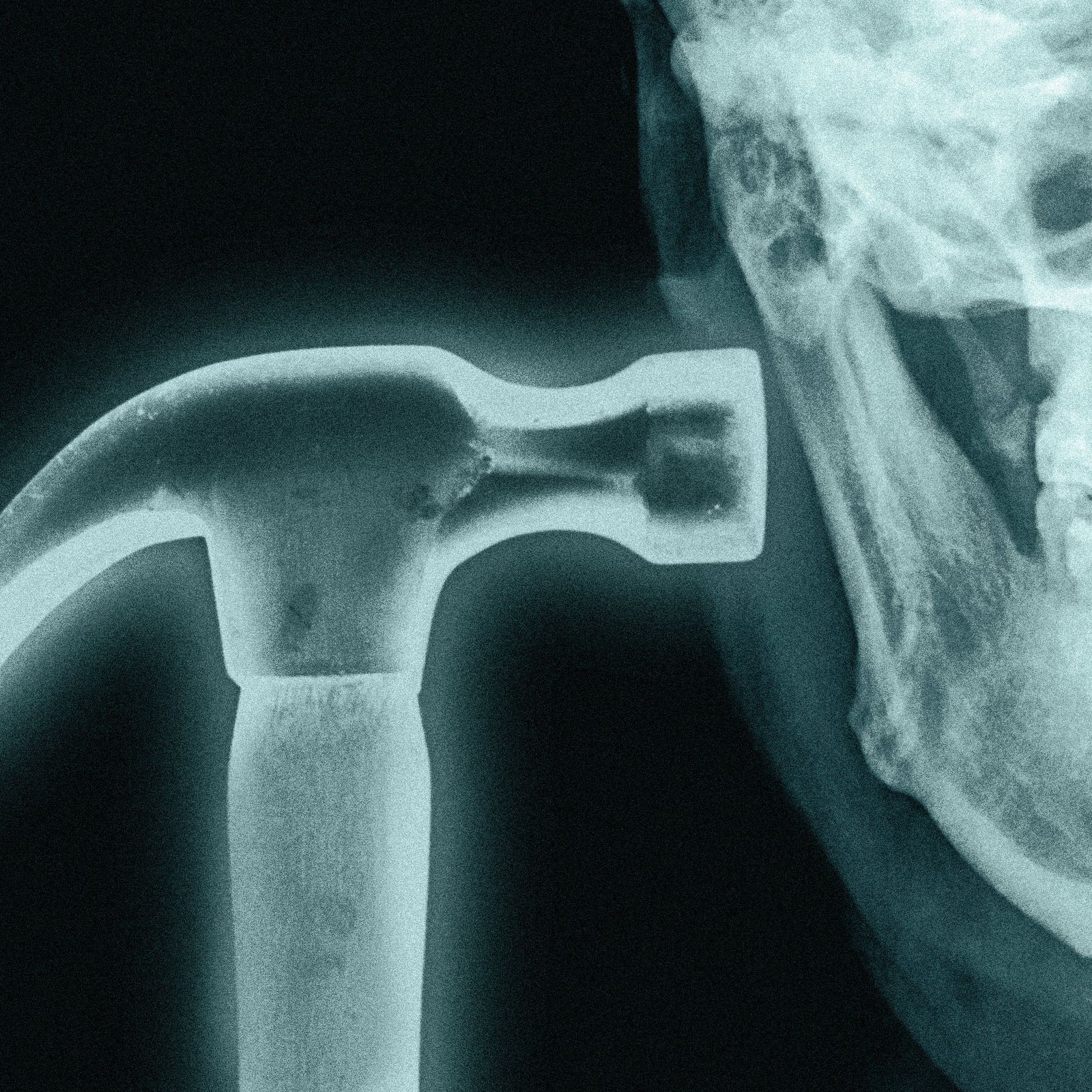 What is Bonesmashing? Inside the Extreme Looksmaxxer Technique