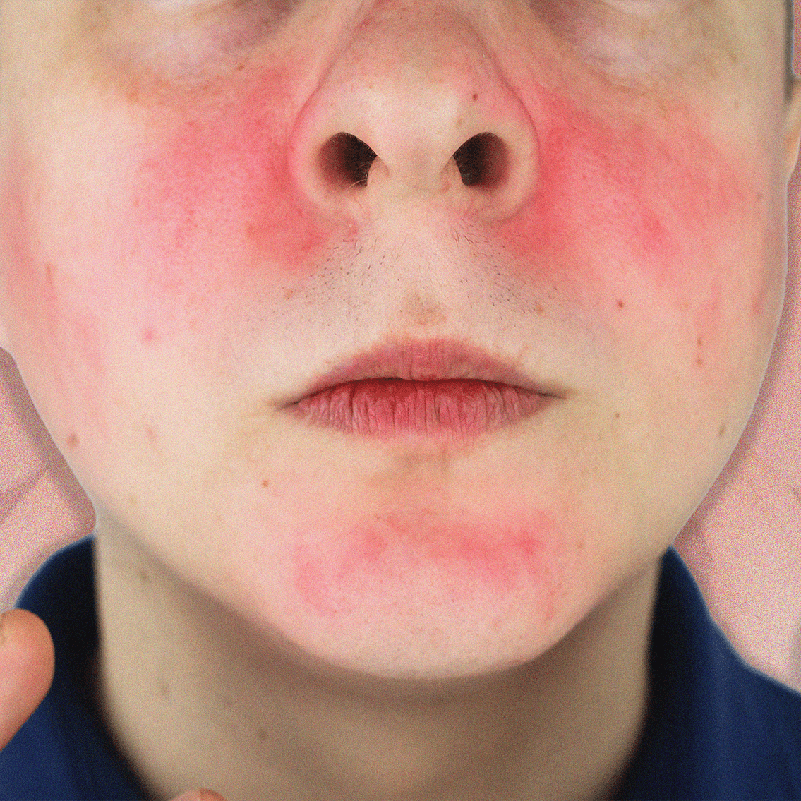 I Found Out I Have Type 1 Rosacea. Now What?